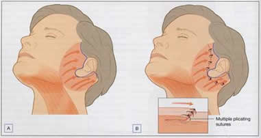 Facelift Procedure